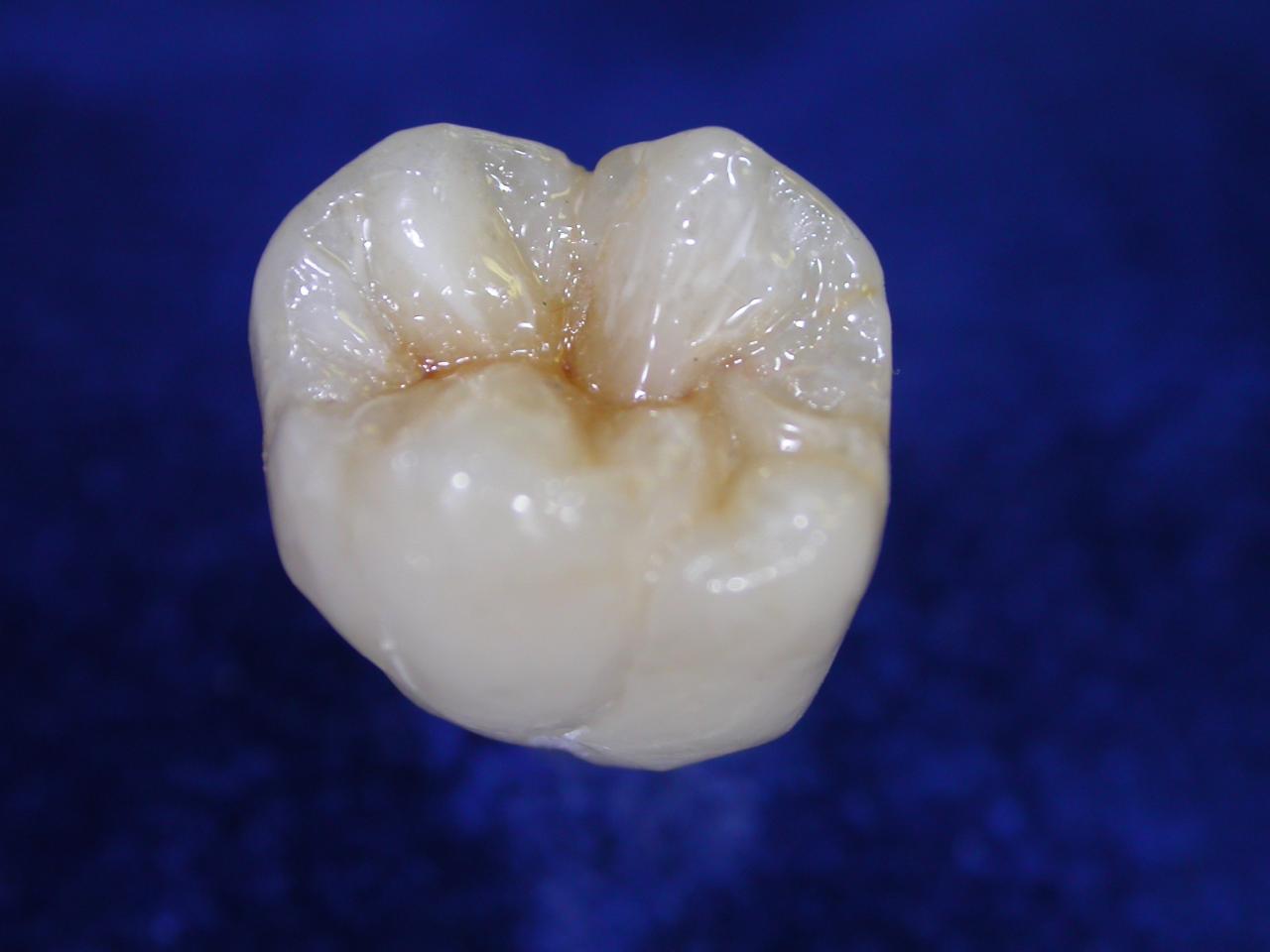 Composite_Molar_1.265105552_large