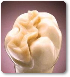 Incrustacion-dental-peru