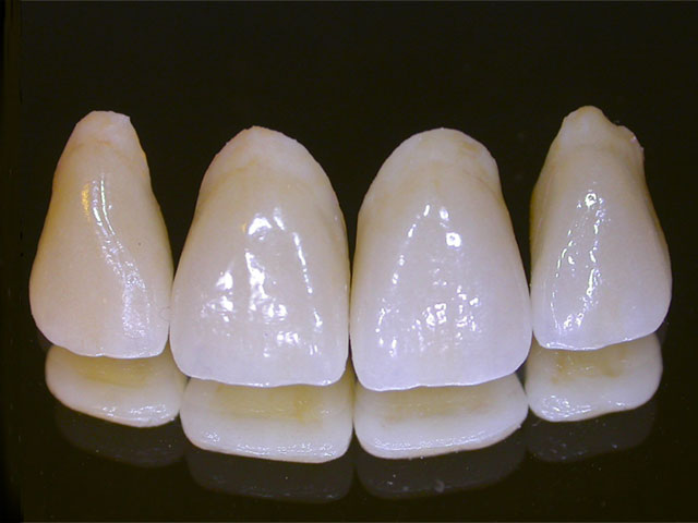 Porcelain_Dental_Crowns