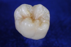 Composite_Molar_1.265105552_large