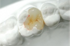 cercon-zirconia2[1]