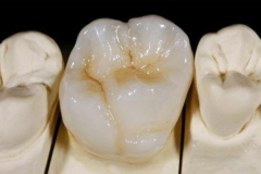 ips-emax-press-molar[1]