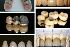 metaloceramica